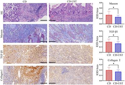 Ustekinumab affects myofibroblast metabolism to alleviate intestinal fibrosis by targeting KDELC1 in Crohn’s disease through multi-machine learning combined with single-cell sequencing analysis